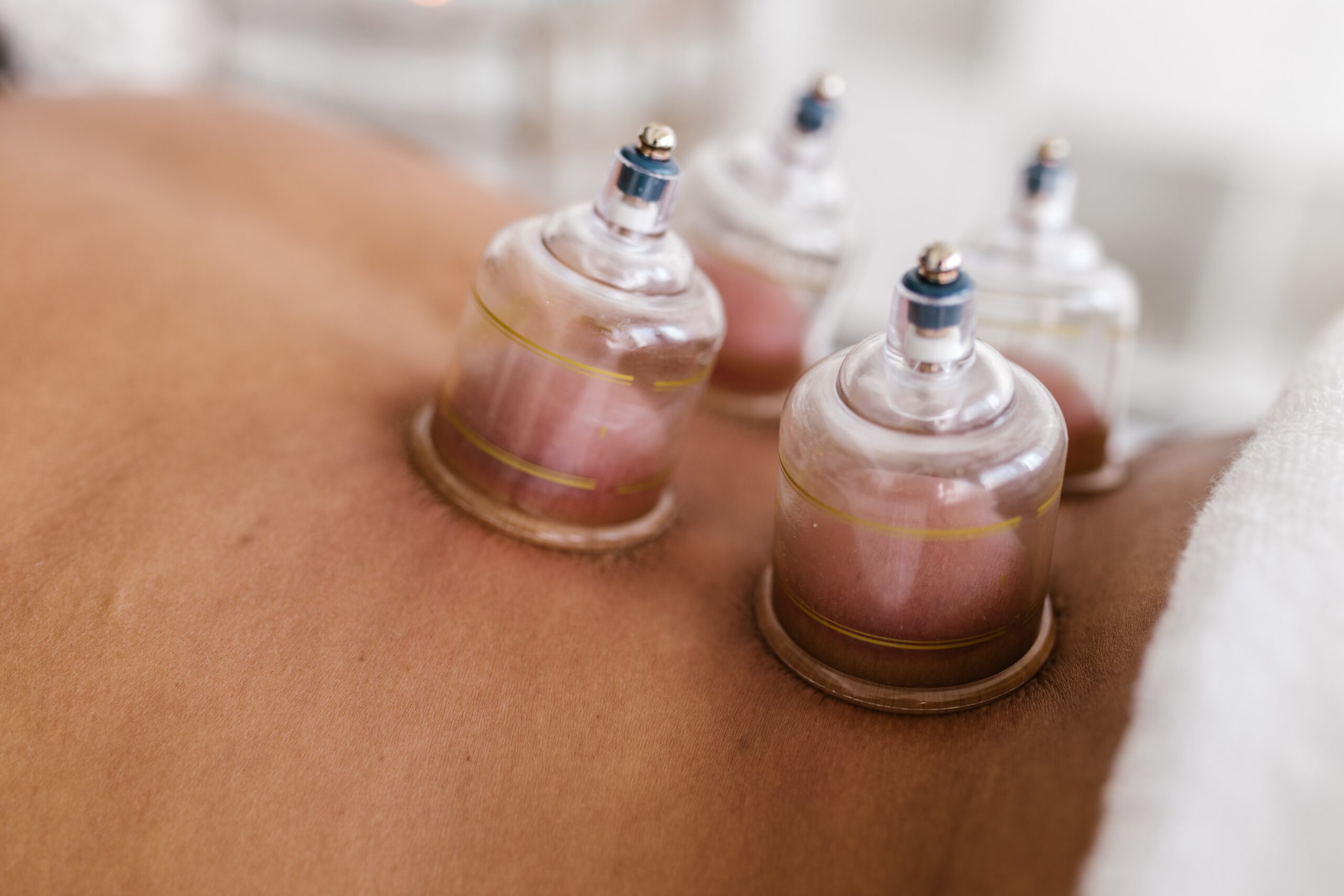 cupping therapy